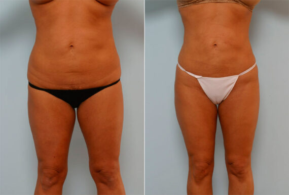 Liposuction before and after photos in Houston, TX, Patient 29108