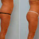 Liposuction before and after photos in Houston, TX, Patient 29108