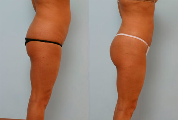 Liposuction before and after photos in Houston, TX, Patient 29108