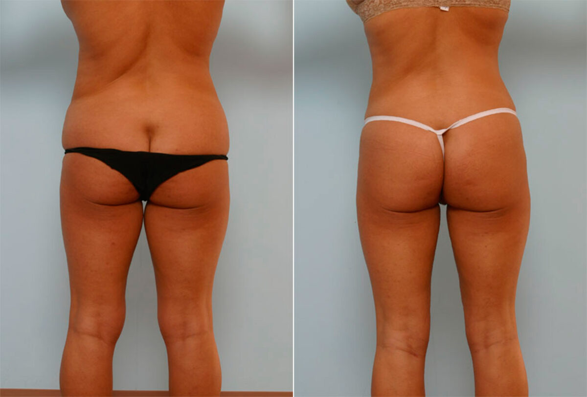 Liposuction before and after photos in Houston, TX, Patient 29108