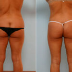 Liposuction before and after photos in Houston, TX, Patient 29108