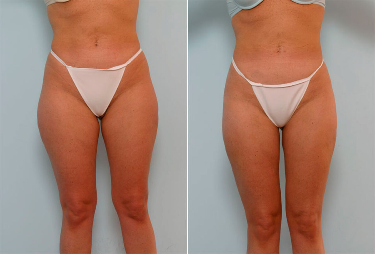 Liposuction before and after photos in Houston, TX, Patient 29115