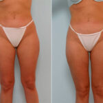 Liposuction before and after photos in Houston, TX, Patient 29115