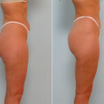 Liposuction before and after photos in Houston, TX, Patient 29115