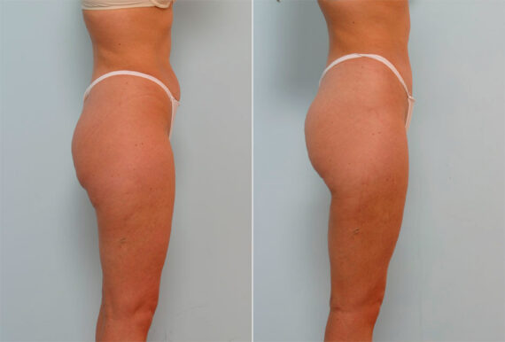 Liposuction before and after photos in Houston, TX, Patient 29115