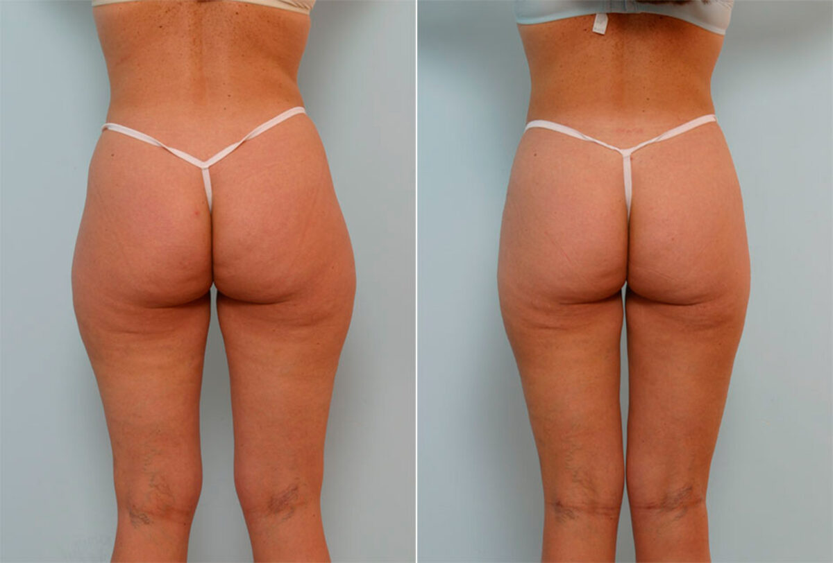 Liposuction before and after photos in Houston, TX, Patient 29115