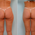 Liposuction before and after photos in Houston, TX, Patient 29115