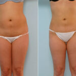 Liposuction before and after photos in Houston, TX, Patient 29129