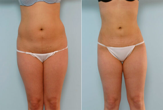 Liposuction before and after photos in Houston, TX, Patient 29129