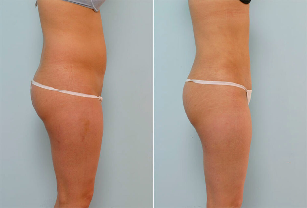 Liposuction before and after photos in Houston, TX, Patient 29129