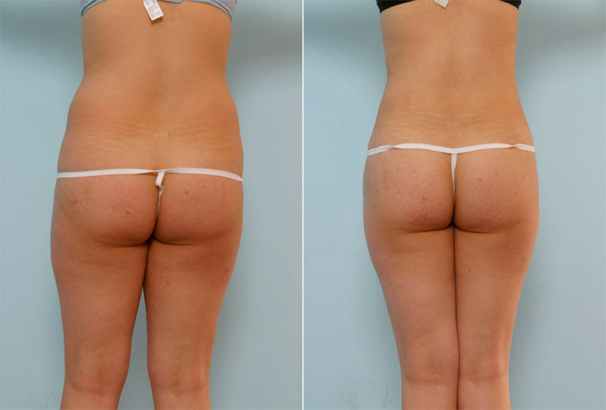 Liposuction before and after photos in Houston, TX, Patient 29129