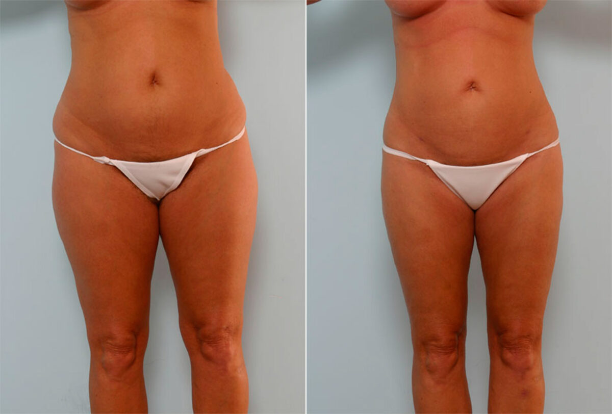 Liposuction before and after photos in Houston, TX, Patient 29136