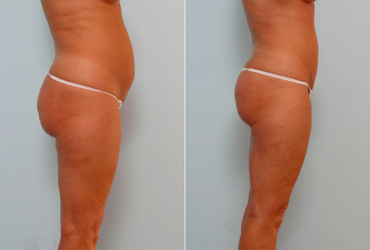 Liposuction before and after photos in Houston, TX, Patient 29136