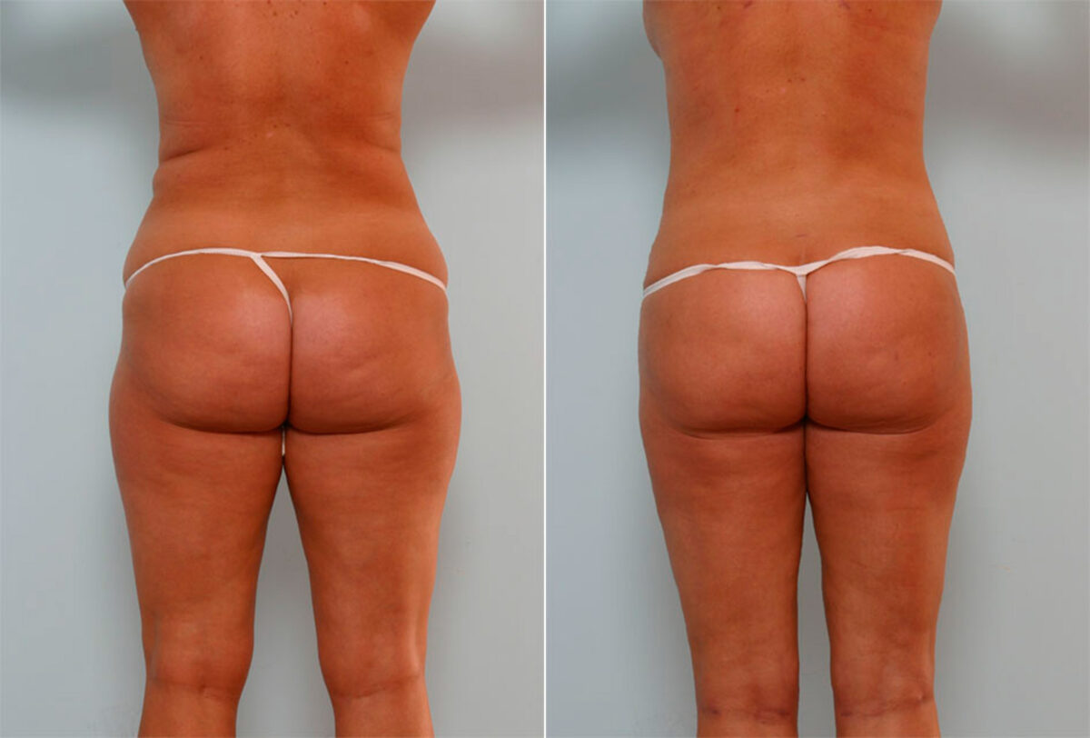 Liposuction before and after photos in Houston, TX, Patient 29136