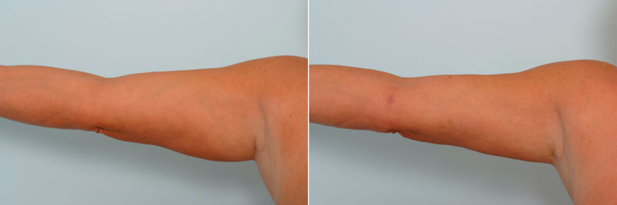 Liposuction before and after photos in Houston, TX, Patient 29136