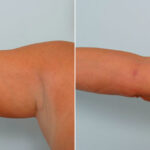 Liposuction before and after photos in Houston, TX, Patient 29136