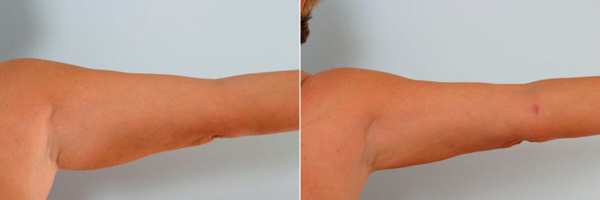 Liposuction before and after photos in Houston, TX, Patient 29136