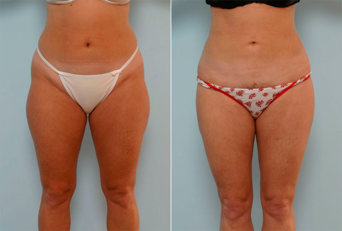 Liposuction before and after photos in Houston, TX, Patient 29147