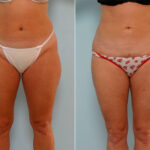 Liposuction before and after photos in Houston, TX, Patient 29147