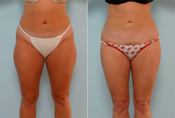 Liposuction before and after photos in Houston, TX, Patient 29147