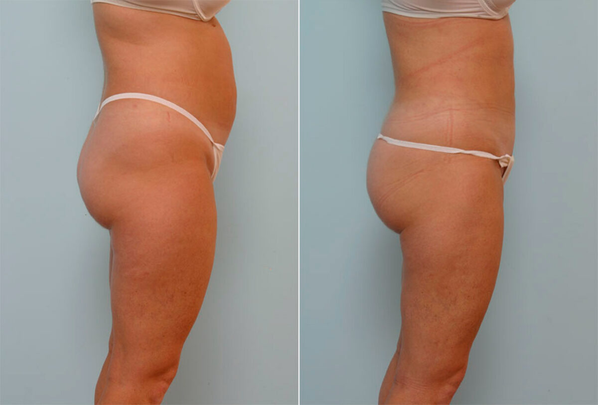 Liposuction before and after photos in Houston, TX, Patient 29147