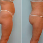 Liposuction before and after photos in Houston, TX, Patient 29147