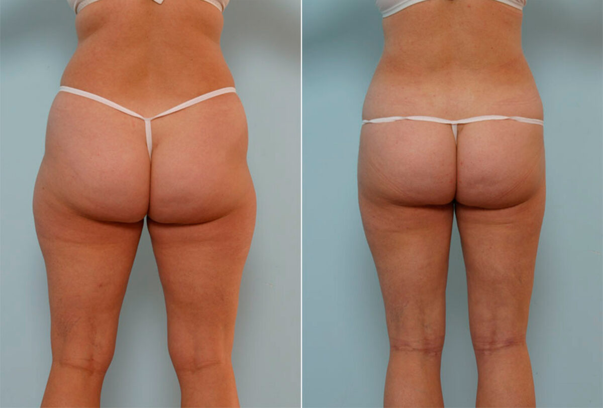 Liposuction before and after photos in Houston, TX, Patient 29147