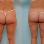 Liposuction before and after photos in Houston, TX, Patient 29147