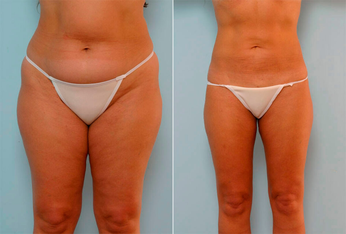 Liposuction before and after photos in Houston, TX, Patient 29161