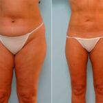 Liposuction before and after photos in Houston, TX, Patient 29161