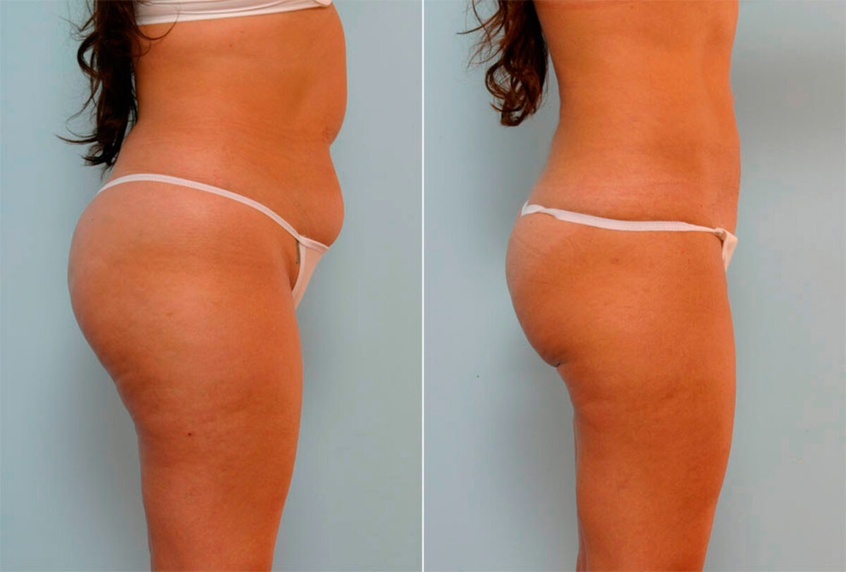 Liposuction before and after photos in Houston, TX, Patient 29161