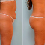 Liposuction before and after photos in Houston, TX, Patient 29161