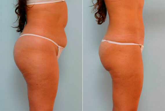 Liposuction before and after photos in Houston, TX, Patient 29161