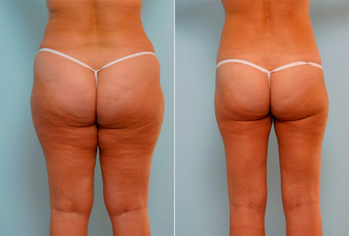 Liposuction before and after photos in Houston, TX, Patient 29161