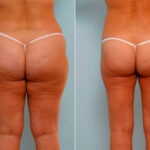 Liposuction before and after photos in Houston, TX, Patient 29161