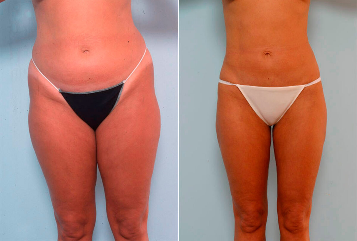 Liposuction before and after photos in Houston, TX, Patient 29168