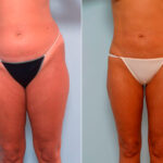 Liposuction before and after photos in Houston, TX, Patient 29168