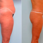 Liposuction before and after photos in Houston, TX, Patient 29168