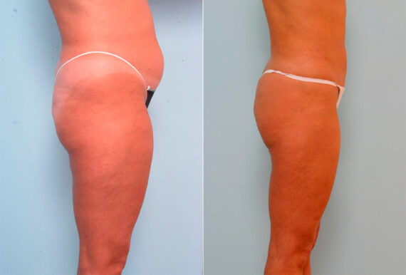 Liposuction before and after photos in Houston, TX, Patient 29168