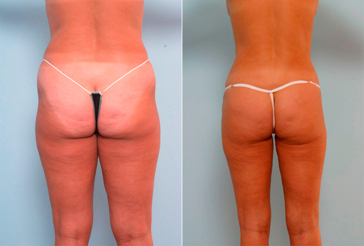 Liposuction before and after photos in Houston, TX, Patient 29168