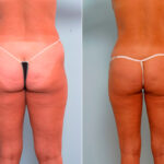 Liposuction before and after photos in Houston, TX, Patient 29168