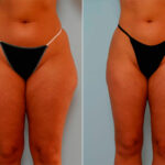 Liposuction before and after photos in Houston, TX, Patient 29175