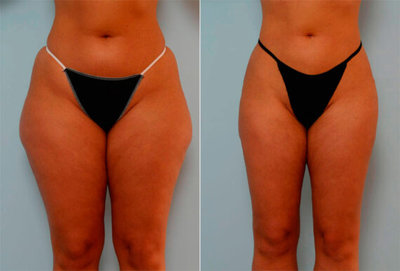 Liposuction before and after photos in Houston, TX, Patient 29175