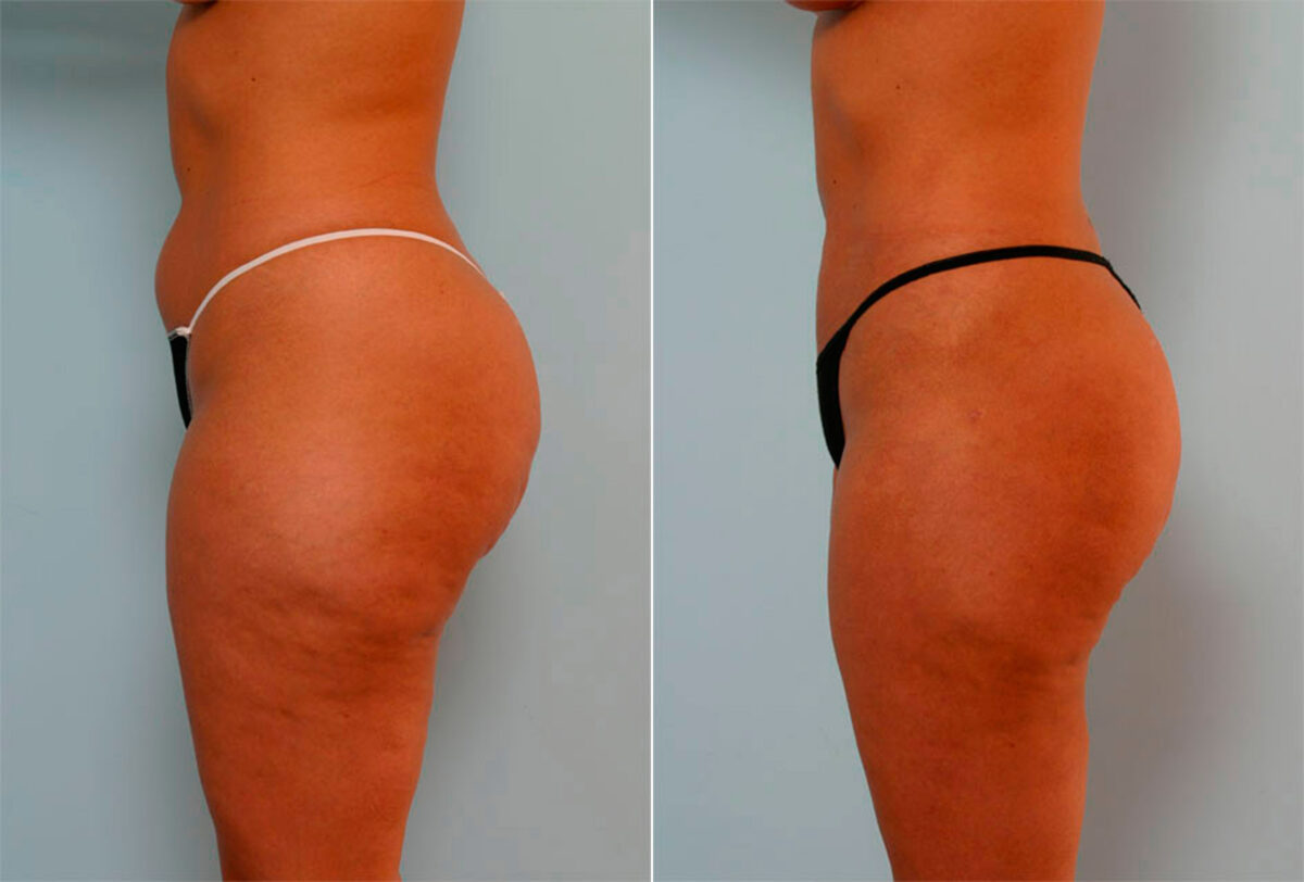 Liposuction before and after photos in Houston, TX, Patient 29175