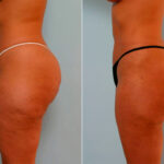 Liposuction before and after photos in Houston, TX, Patient 29175