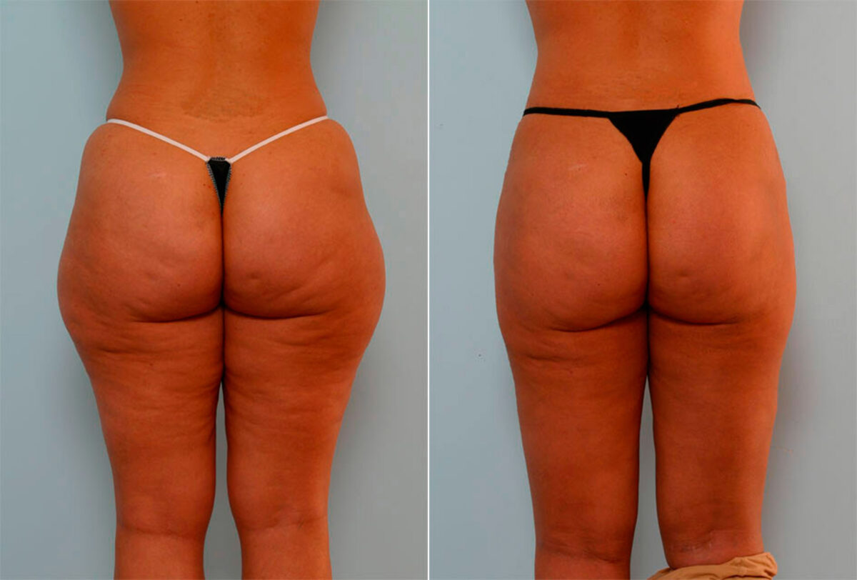 Liposuction before and after photos in Houston, TX, Patient 29175