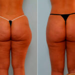 Liposuction before and after photos in Houston, TX, Patient 29175