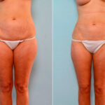 Liposuction before and after photos in Houston, TX, Patient 29182