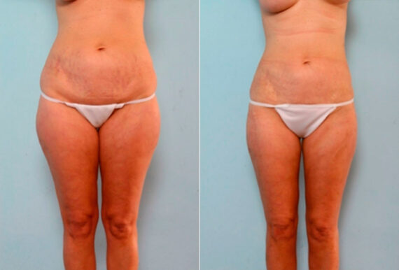 Liposuction before and after photos in Houston, TX, Patient 29182