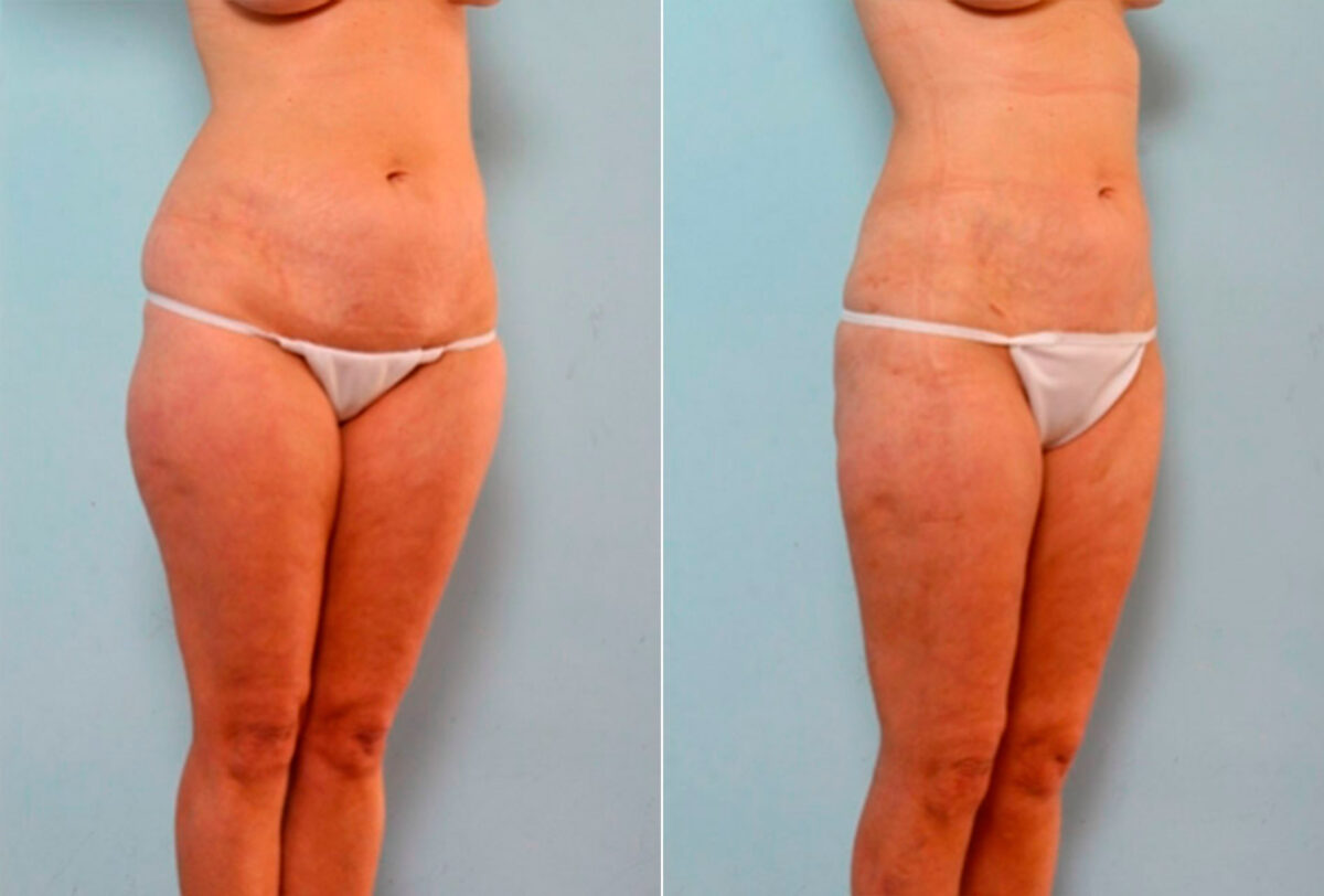 Liposuction before and after photos in Houston, TX, Patient 29182